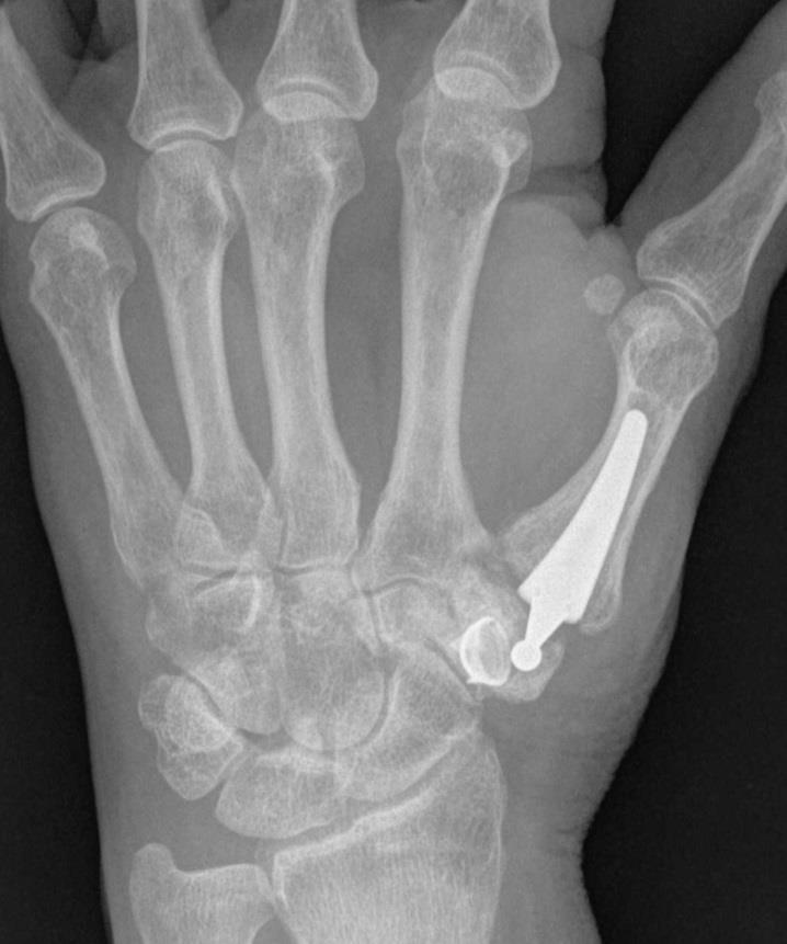 implant failure: acetabulum loosening, dislocation, perforation and fracture of trapezium, CRPS possible
