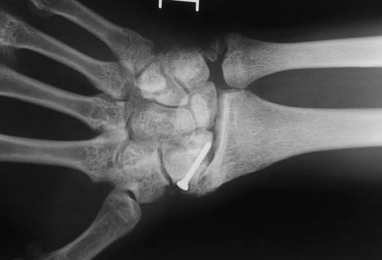 Arthritis pattern fracture of radius