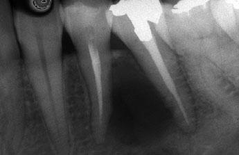 for root canal treatment. The treatment plan may be complicated when a radiolucent lesion surrounds a previously root-filled tooth.