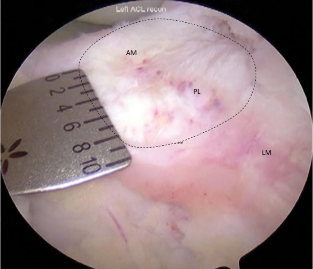 points. During the arthroscopic procedure, the surgeon will identify the ACL remnant and remove the ruptured ACL with a scalpel, effectively exposing the ACL footprint and its fibres.