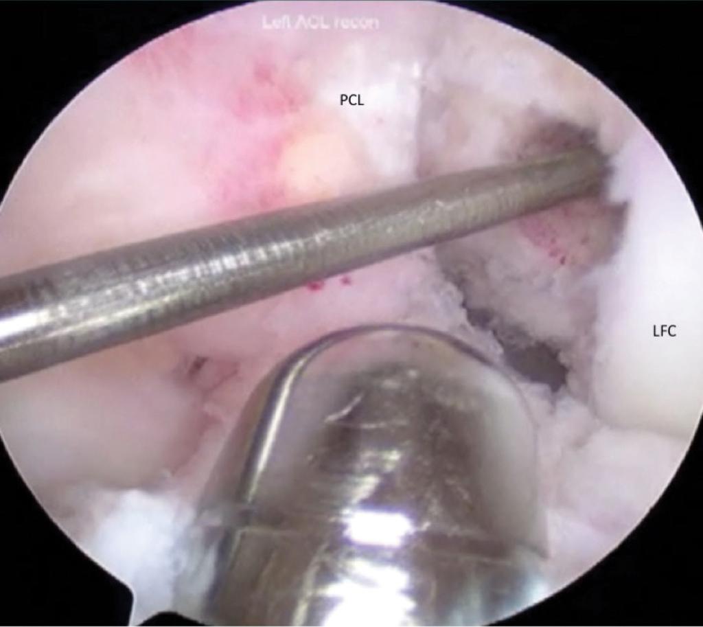 7 8 Figure 7: Arthroscopic view, from the central portal, of the femoral tunnel with drilling pin and tibial tunnel dilator.