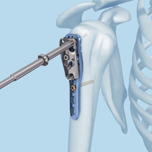 5 Predrill the lateral cortex and determine proximal screw length Proximal humerus fractures are common in osteoporotic bone.