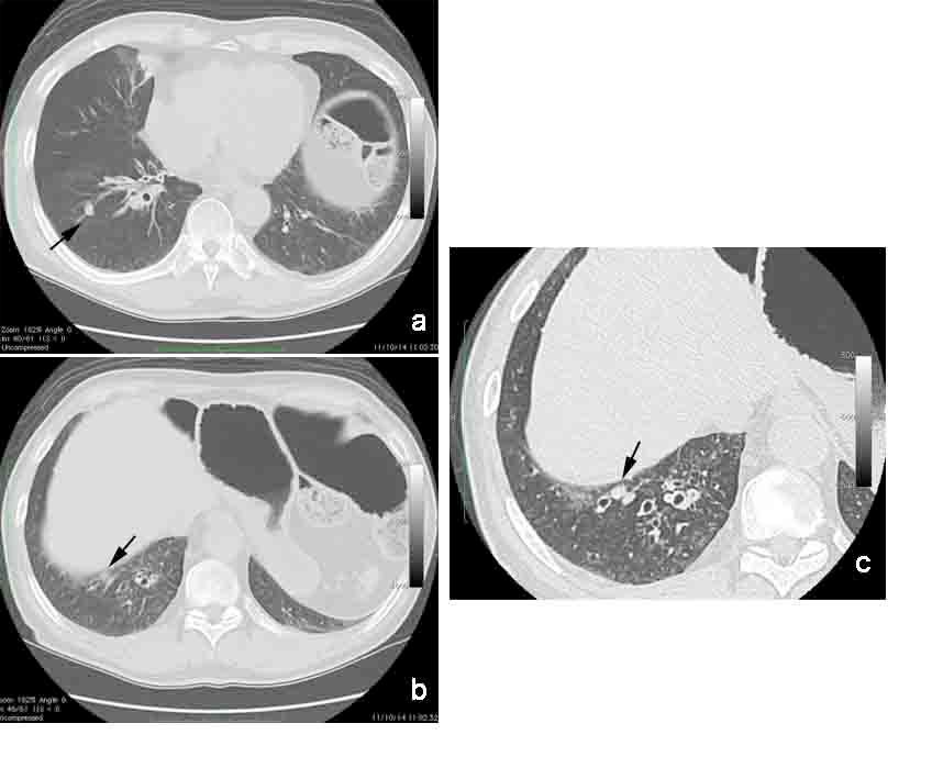 Primary Lung Cancer Coexisting with Lung Metastases from Various Malignancies 19 Figure 3.