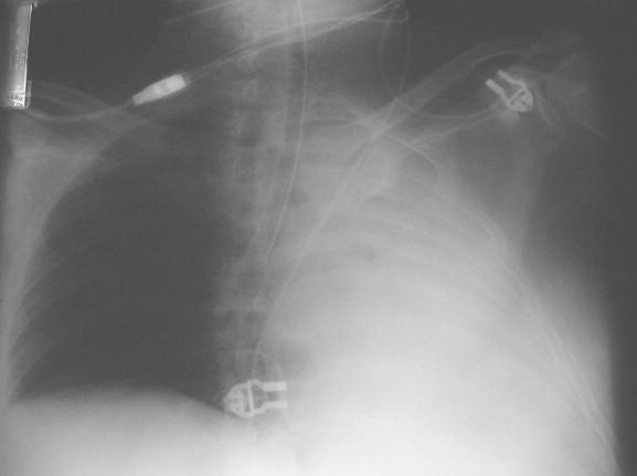 1 PULMONARY COLLAPSE: A cause of opacity on chest X-ray but there are several features to distinguish it from alveolar shadowing or interstitial lung disease.