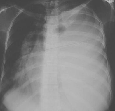 10 : Completely opaque L hemithorax with displacement of the trachea & mediastinum to the R side. This was a patient with a massive pleural effusion. Completely opaque L hemithorax. Again there is displacement of the trachea & mediastinum to the R side.
