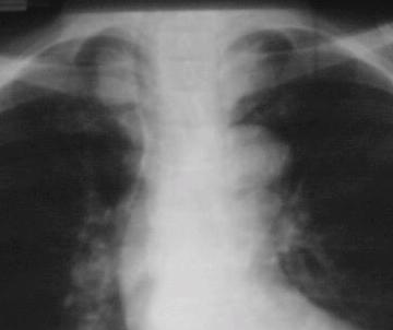 Although the mediastinum is divided into compartments for descriptive & diagnostic purposes, masses may freely cross from one part to another.