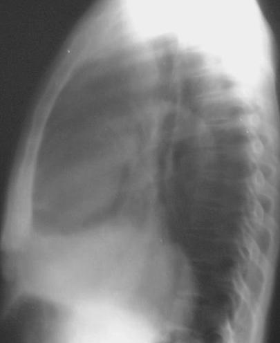 A sail sign is seen to the R of the mediastinum There is considerable enlargement of the mediastinum projecting
