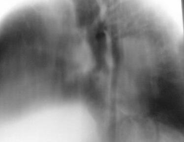 The film is of inferior quality because the spinous processes cannot be seen through the cardiac shadow. It is not possible to assess the mediastinum on such a film.