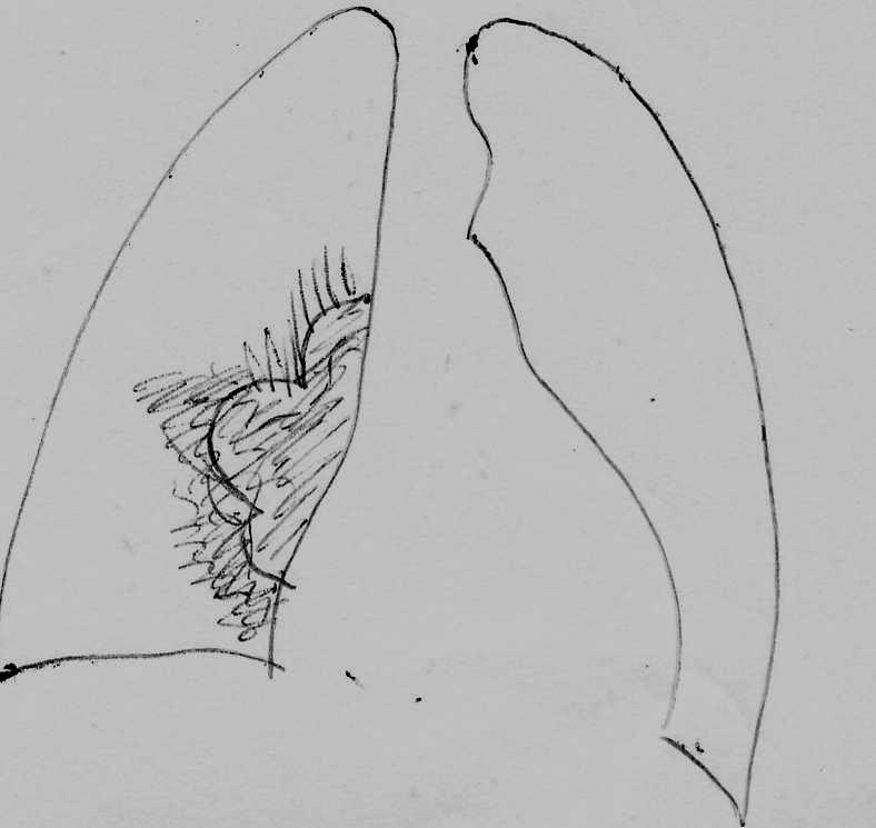 pulmonary artery (enlargement of artery) - Mediastinal mass superimposed on a hilum R hilar adenopathy.