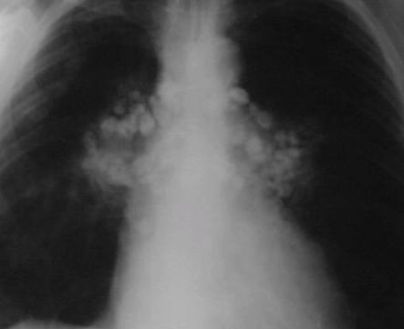 are convex in shape. This patient has erythema nodosum and the hilar enlargement is due to adenopathy. Calcified hilar nodes: These are most commonly seen in tuberculosis and are usually unilateral.