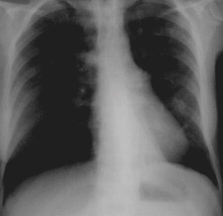 Collapse middle lobe As this is a relatively small lobe collapse produces only minor changes on the PA film. There is increased density lateral to the R heart border & blurring of the outline.