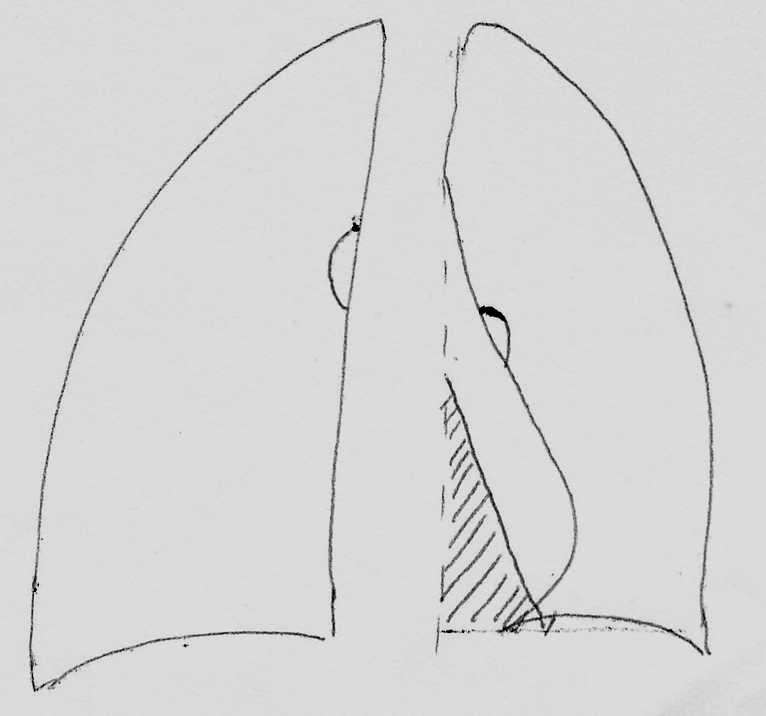 There is a density next to the heart, below the R hilum, which is roughly triangular in shape Lateral view shows the middle lobe collapse more clearly.