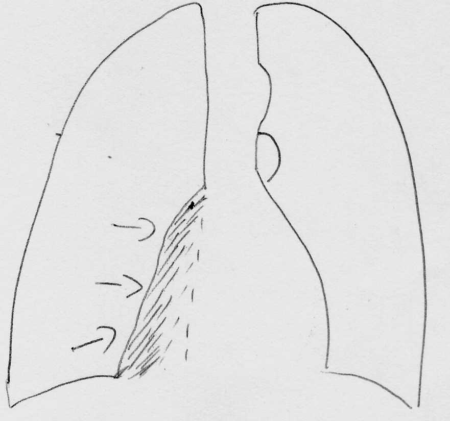 The only clue is that the spine appears of even density throughout whereas normally it looks darker in the lower part of the chest R lower lobe collapse produces shadowing adjacent to the R heart
