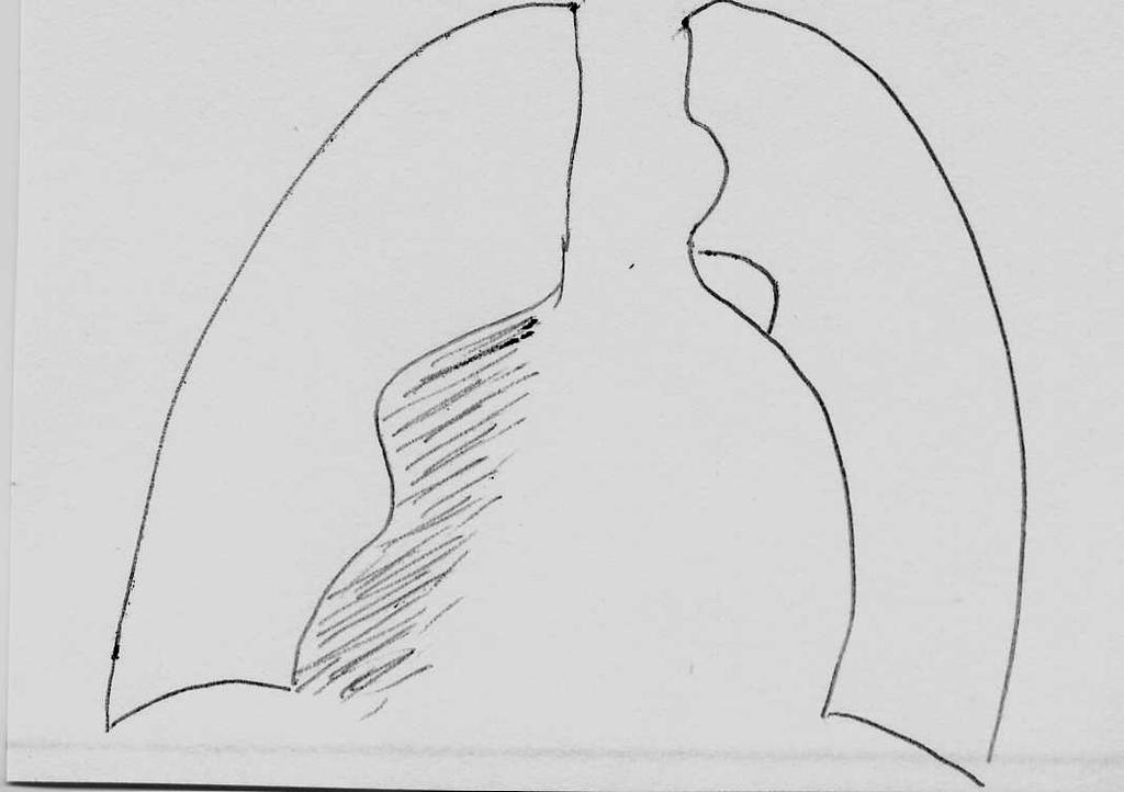 In collapse of the R middle & lower lobe the shadowing is greater and more obvious Homogenous shadowing in the R lower zone. The lesser fissure is bowed inferiorly.