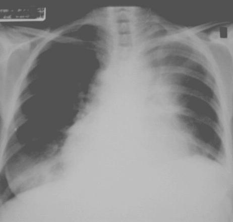 4 Collapse L upper lobe producing hazy ill defined shadowing adjacent to the L mid & upper mediastinum.