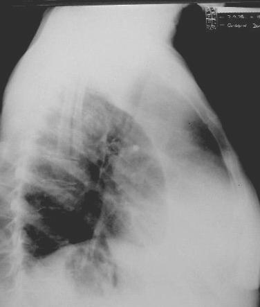 Small linear subsegmental atelectatic shadows at the lung bases are called plate atelectasis and are due to poor aeration or perfusion.
