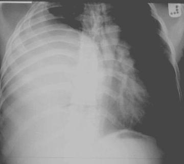 The heart & mediastinum are displaced to the L The opacity arrowed is due to a