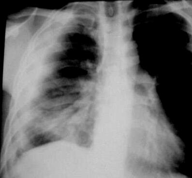 7. Diagrammatic representation of the chest X-ray. There are 4 loculated pleural collections.