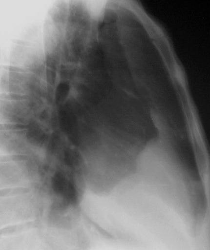 More common over the lung bases, often calcified - asbestos exposure irregular pleural thickening and plaques. Common in the axillary region. Calcification is common.
