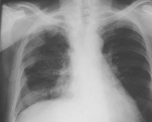 CAUSES OF A TOTALLY OPAQUE HEMITHORAX: Occasionally a completely hemithorax is encountered.