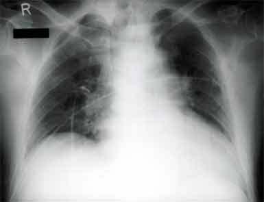 Figure legends Figure 1: Anteroposterior radiograph of the chest shows prominent perihilar shadows