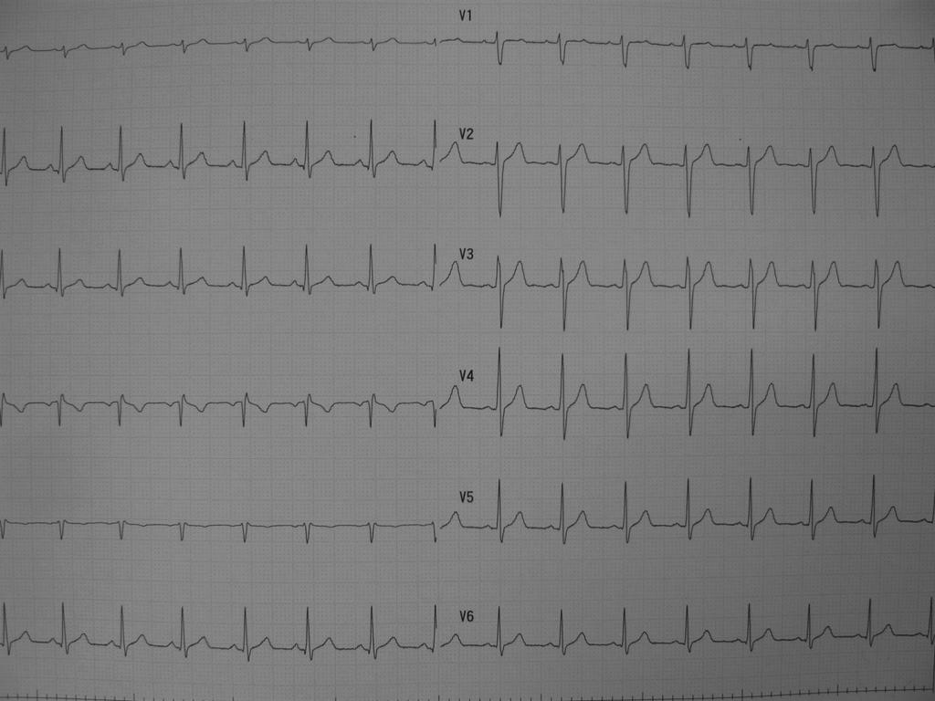 ECG * Tachycardia NSR *