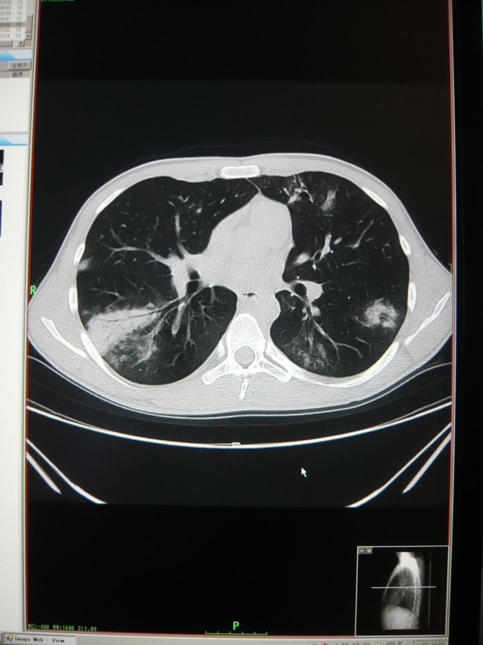 Chest CT CT of the chest shows multiple