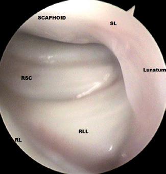 V úvode artroskopie zápästia, najmä pri diagnostike môžeme artroskopickej diagnostiky a artroskopickej sutúry ruptury lig. scaphoideolunatum urobiť tzv.