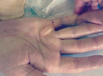 Obr. 2a Obr. 2b Obr. 2c Obr. 2d Obr. 2e Obr. 2: 68-ročný polymorbídny pacient s Dupuytrenovou kontraktúrou piateho prsta s pozitívnym stolovým testom (tzv.