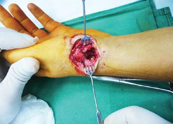 Volárna rekonštrukcia väzu tograftu môžu byť šľachy flexor carpi plastickej a rekonštrukčnej chirurgie sa môže považovať za možnosť liečby pre radialis (FCR), extensor carpi radialis Na klinike