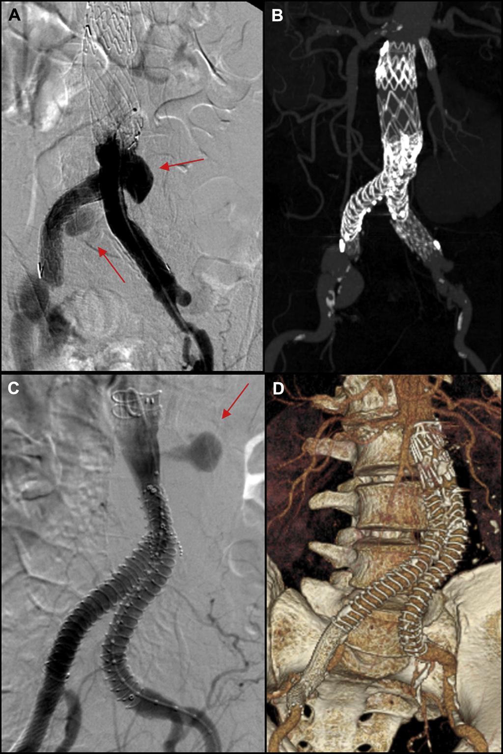 250 Pini et al December 2015 Fig 1. Patient 1 (A and B) and patient 3 (C and D). A, Preoperative digital subtraction angiography (DSA) of a type IIIb endoleak from both iliac limbs (arrows).
