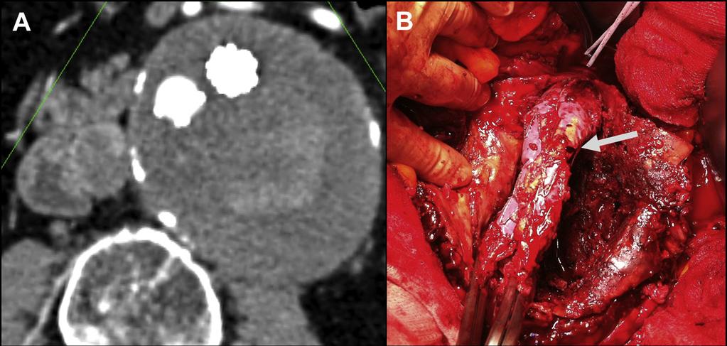 252 Pini et al December 2015 Fig 3. Patient 6. A, Preoperative computed tomography angiography (CTA) with possible type II endoleak. B, Intraoperative identification of an endograft tear (arrow).