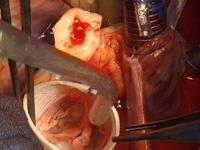 Aortic Root Remodeling Aortic valve preservation