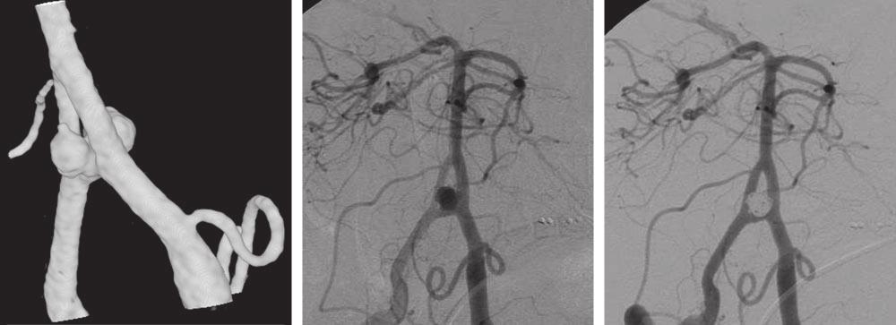A B C Fig 2. A 64-year-old man with ruptured vertebrobasilar junction aneurysm.