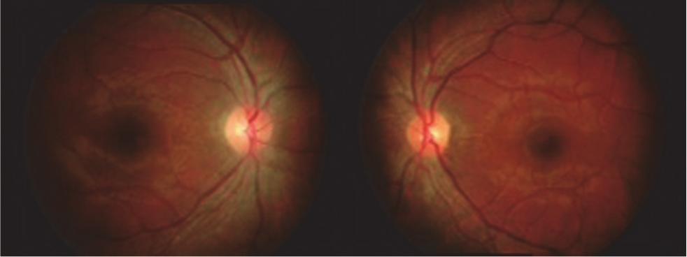 Figure 3: Fundus photo after six weeks of treatment showing resolution of the optic disc swelling and haemorrhages bilaterally. examination was normal.