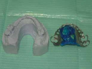 Condensation silicone impression of resection cavity on cast framework of obturator prosthesis. Slika 5.