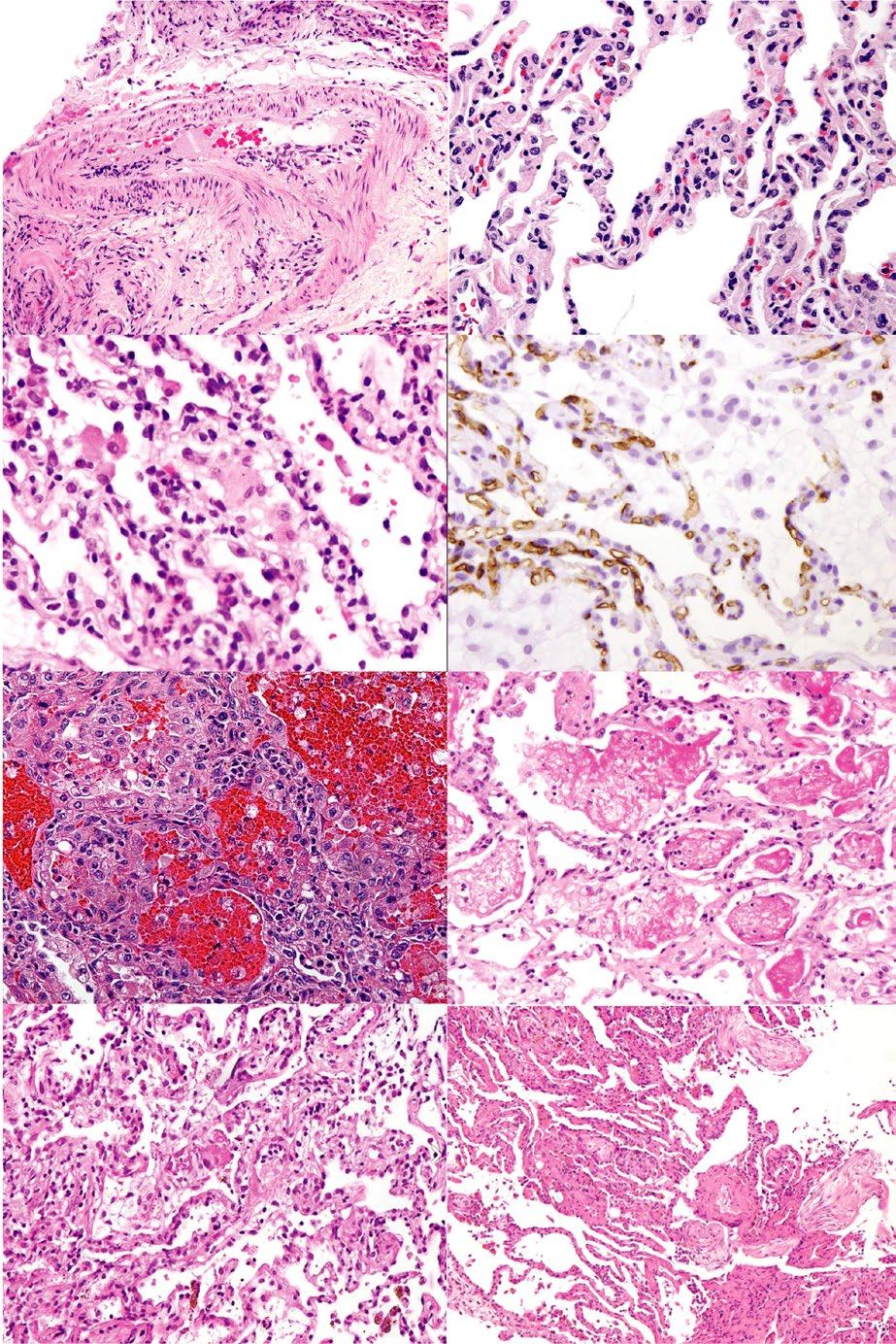 ROUX et al. 5 A B C D E F G H FIGURE 1 Panel of histologic features evocative of AMR. (A) Arteritis in a patient with definite AMR.