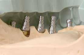 The cylindrical guide shaft prevents abrasion in the sleeves. Fig. 19: Insertion of the SCREW-LINE implants CAMLOG Guide, Promote plus. Fig. 20: As on the model one groove of the inner configuration of the six inserted implants is directed vestibular in each case.