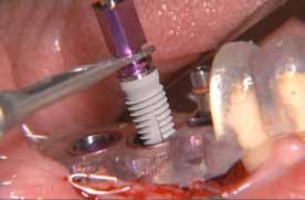 39: All interdental spaces, also in the region of the implants, can be cleaned well with interdental brushes. Fig.