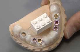 With the aid of the software (implant3d, med 3D), the implant positions and lengths can be planned precisely in terms of the final prosthetic restoration (Fig. 8).