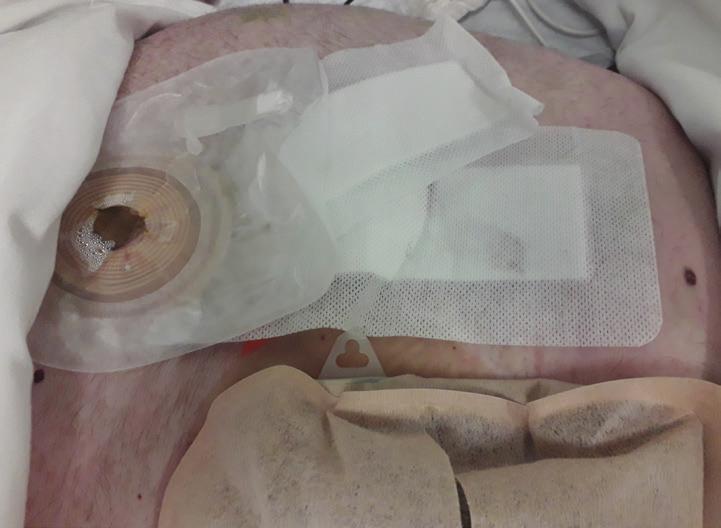 Figure 3. Case 3: Dressings and stoma bag in place (head at top) Figure 4. Case 4: After first dressing removal with Lifteez Figure 5. Case 5: At initial assessment at dressing removal.