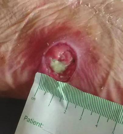 Lifteez used on abdominal wound dressing and stoma pouch (LM) Mr A is 56 years old and an inpatient at the rehabilitation unit following 3 months in ICU post-laparotomy.