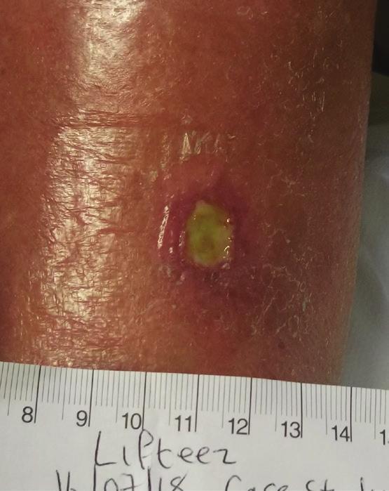 With the use of Lifteez, a more strongly adhesive dressing could be used for this patient with fragile skin, and removed without causing skin trauma. Case 6.