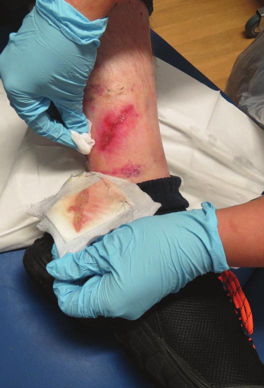 A hydrogel dressing with a simple adhesive secondary dressing had been in place for 5 days. The patient had fragile skin and reported that, in the past, dressing removal had pulled on her skin.