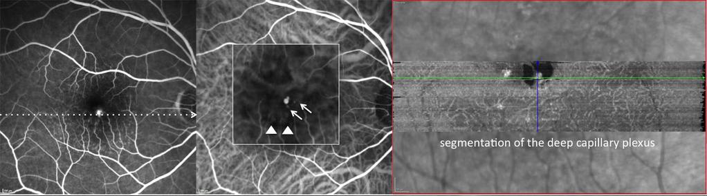 discontinuity of the RPE band through which the hyperreflective intra retinal lesion