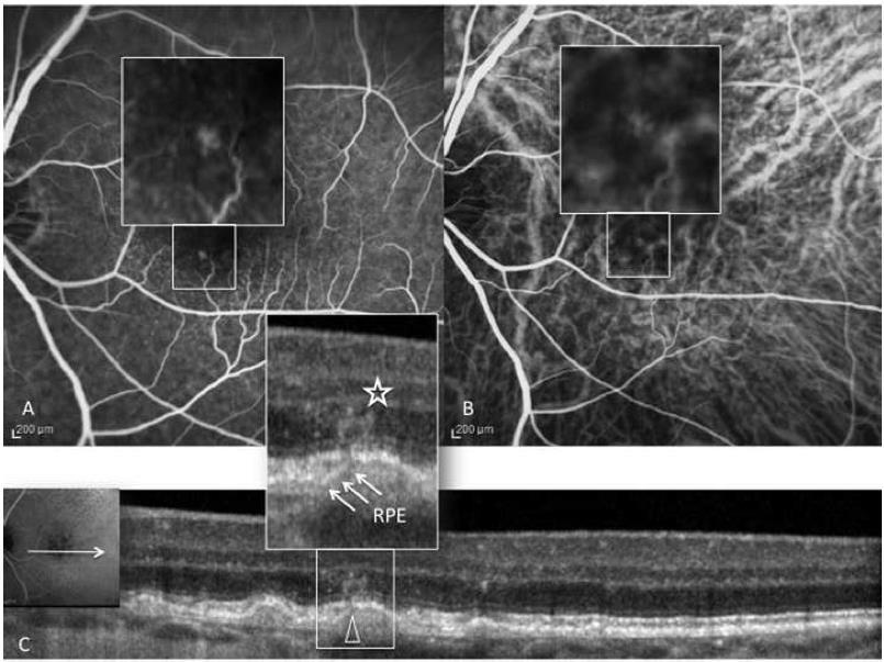 Multimodal Imaging of Type 3 Neo Primarily intraretinal proliferation and anastomoses between retinal vessels and evolving type 1 neovascular