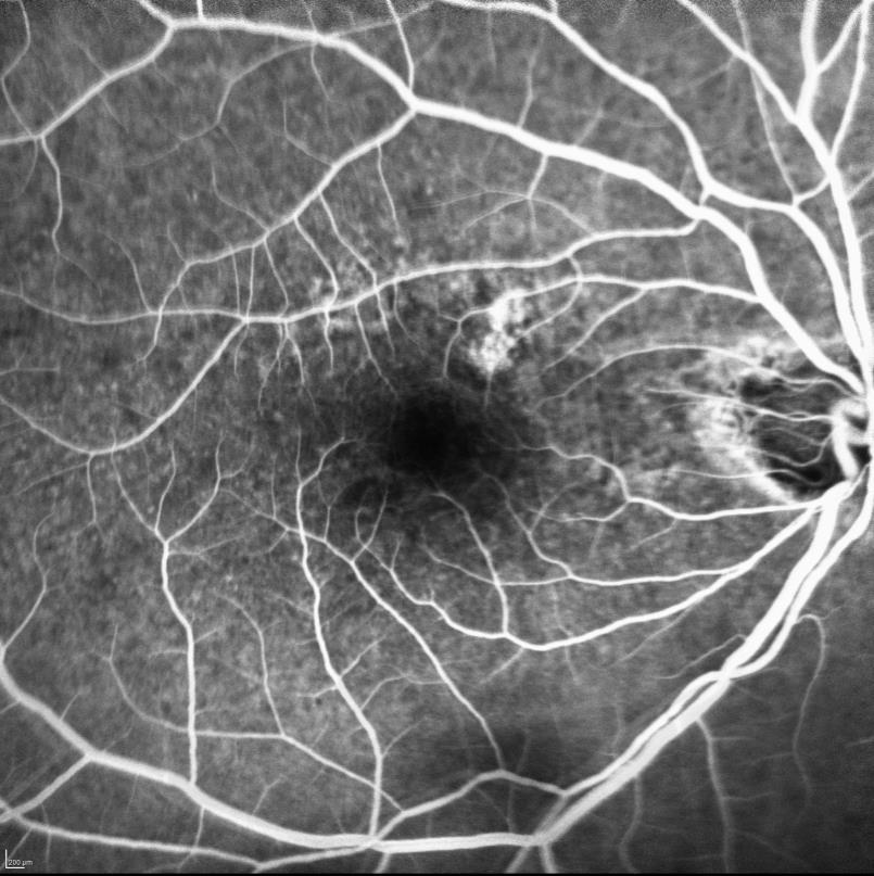 1 Early AMD ischaracterized by the presence of macular drusen and retinal pigment epithelium (RPE) changes.