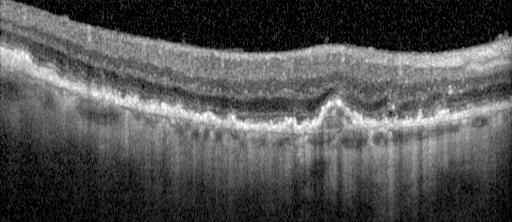 7 10 Almost 80% of patients with AMD with vision loss have the exudative advanced form of the disease, 11 which is characterized by the development of choroidal