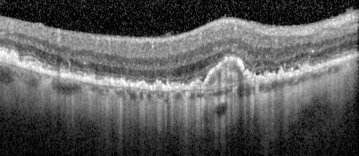 exudative retinal changes; the remaining 20% of the patients with AMD who develop marked vision loss have the atrophic form of the disease.