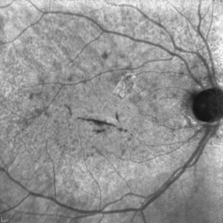 7 10 Almost 80% of patients with AMD with vision loss have the exudative advanced form of the disease, 11 which is characterized by the development of choroidal neovascularization (CNV) in the